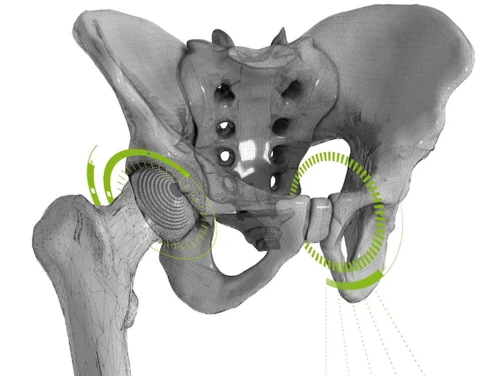 Corin OPS Optimized Positioning System surgical planning for hip replacement
