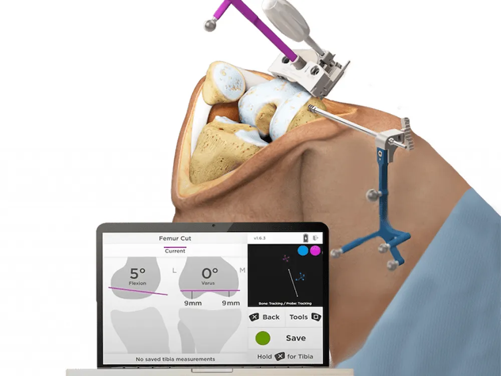 Intellijoint KNEE optical navigation system for knee replacement